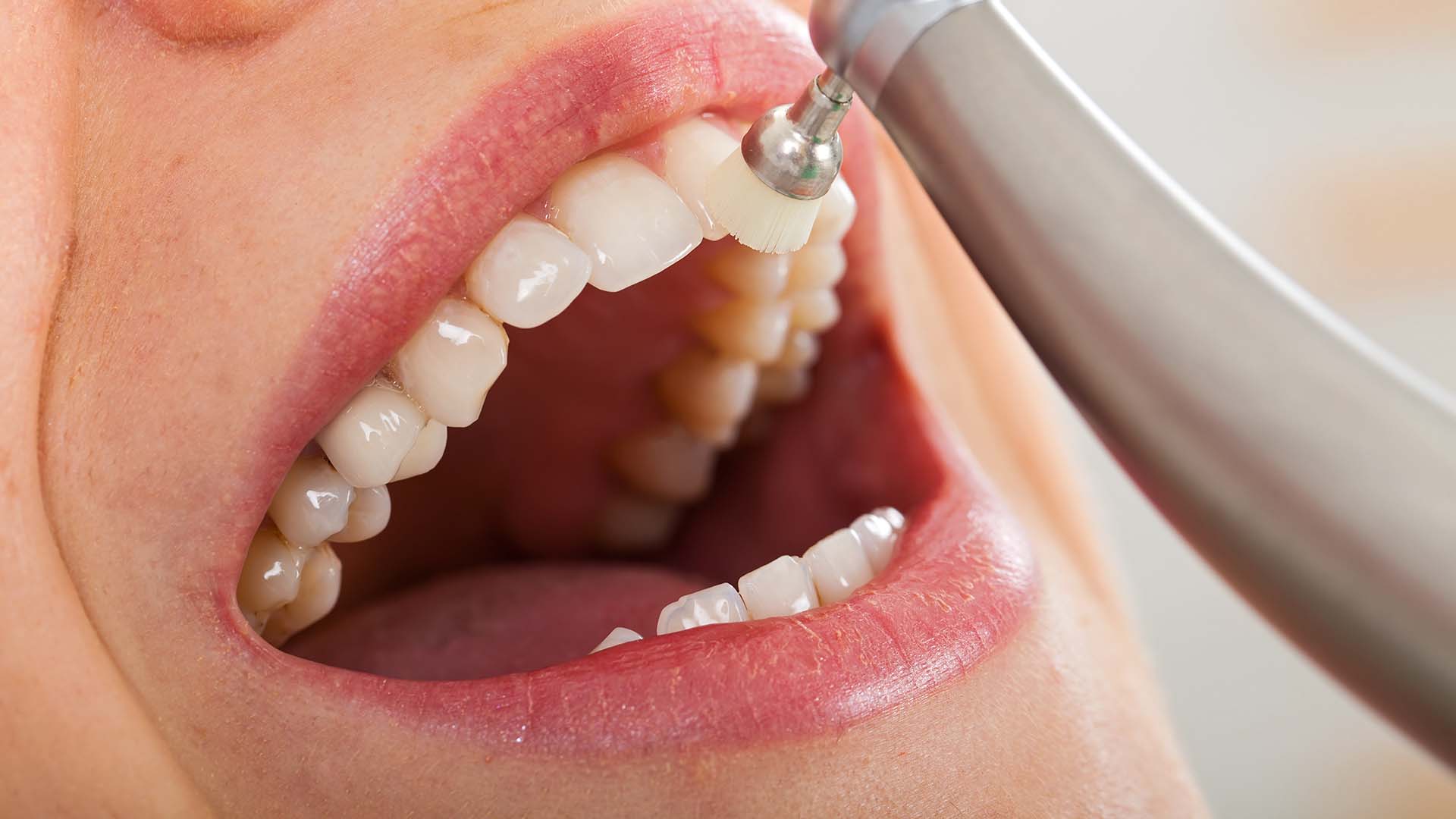 Igiene dentale e prevenzione